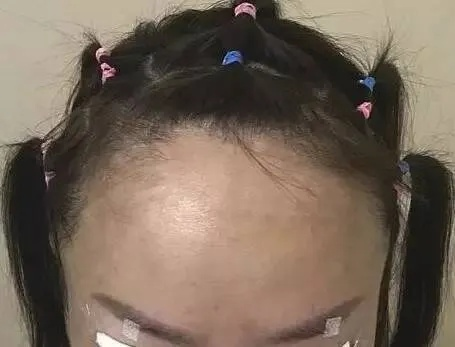 无需羞怯！发际线告别分离，拯救脱发烦恼，重拾自信迎接新生活